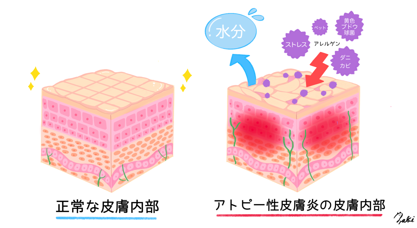 アトピー性皮膚炎　アイキッズクリニック　小児科