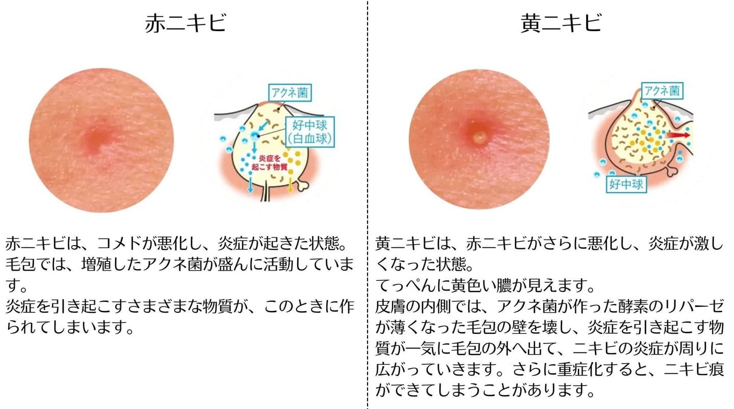 炎症を起こしたニキビについて説明のイラスト